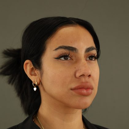 Rhinoplasty Before & After Patient #9990