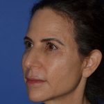 Regenelift™ Facelift Before & After Patient #9993