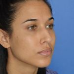 Rhinoplasty Before & After Patient #9995