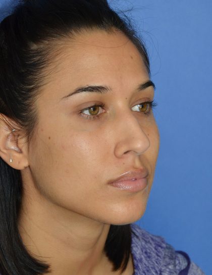 Rhinoplasty Before & After Patient #9995