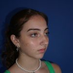 Rhinoplasty Before & After Patient #9996