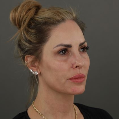 Rhinoplasty Before & After Patient #9997