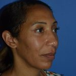Regenelift™ Facelift Before & After Patient #9998