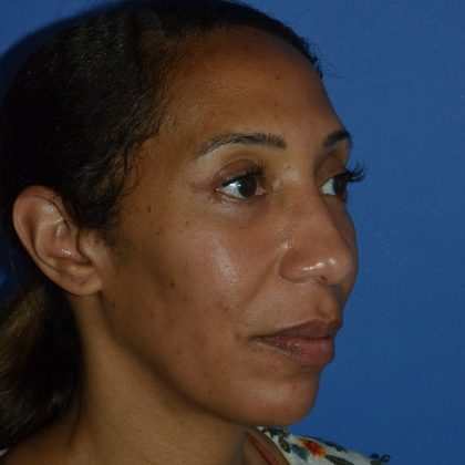Regenelift™ Facelift Before & After Patient #9998