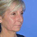 Regenelift™ Facelift Before & After Patient #9786