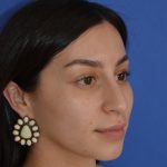Rhinoplasty Before & After Patient #9999