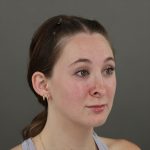 Rhinoplasty Before & After Patient #10000