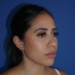 Browlift Before & After Patient #10001