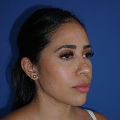 Browlift Before & After Patient #10001