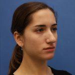 Rhinoplasty Before & After Patient #9790