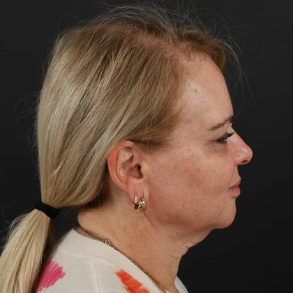 Regenelift™ Facelift Before & After Patient #9793