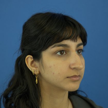 Rhinoplasty Before & After Patient #9986