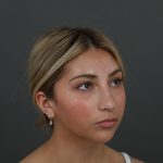 Rhinoplasty Before & After Patient #9987