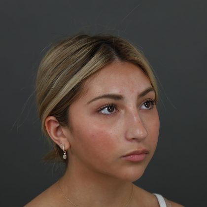 Rhinoplasty Before & After Patient #9987