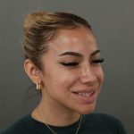 Rhinoplasty Before & After Patient #9990