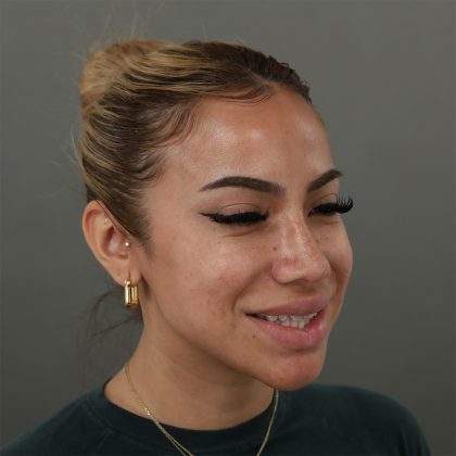 Rhinoplasty Before & After Patient #9990