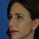 Regenelift™ Facelift Before & After Patient #9993