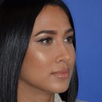 Rhinoplasty Before & After Patient #9995