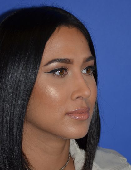 Rhinoplasty Before & After Patient #9995