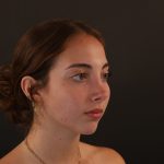 Rhinoplasty Before & After Patient #9996