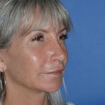 Regenelift™ Facelift Before & After Patient #9786