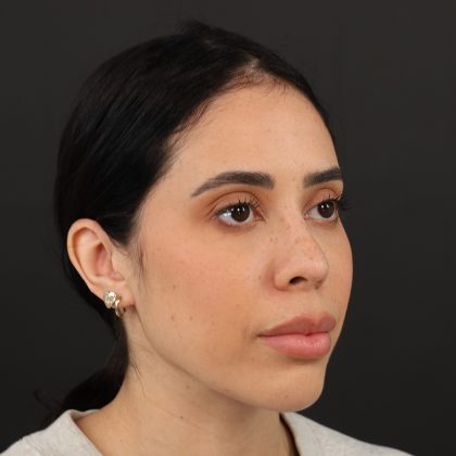 Browlift Before & After Patient #10001