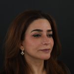 Regenelift™ Facelift Before & After Patient #9788