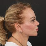 Regenelift™ Facelift Before & After Patient #9793