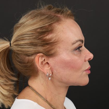 Regenelift™ Facelift Before & After Patient #9793