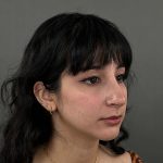 Rhinoplasty Before & After Patient #9986