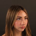 Rhinoplasty Before & After Patient #9987