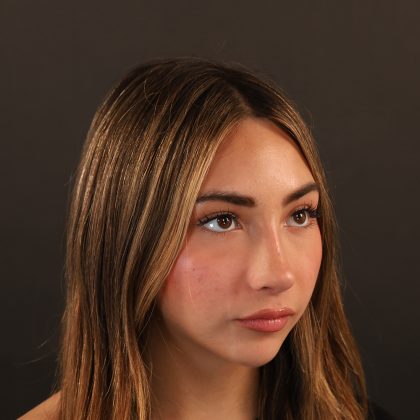 Rhinoplasty Before & After Patient #9987