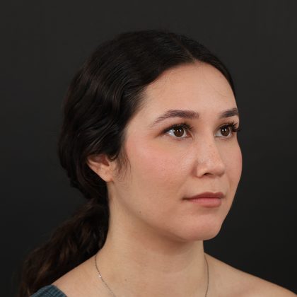 Rhinoplasty Before & After Patient #9988