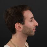Rhinoplasty Before & After Patient #9785