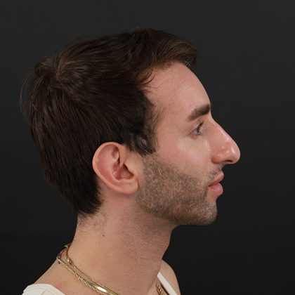 Rhinoplasty Before & After Patient #9785
