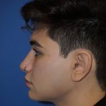 Rhinoplasty Before & After Patient #9989