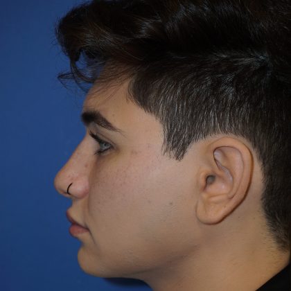 Rhinoplasty Before & After Patient #9989