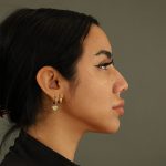 Rhinoplasty Before & After Patient #9990