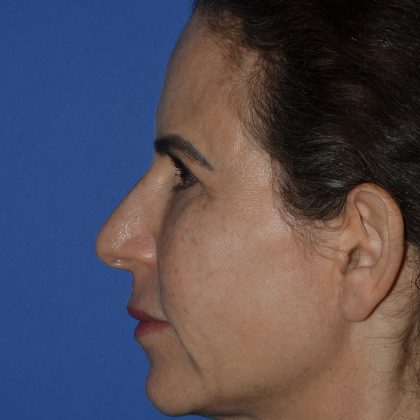 Regenelift™ Facelift Before & After Patient #9993