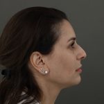 Rhinoplasty Before & After Patient #9994