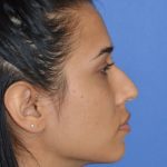 Rhinoplasty Before & After Patient #9995