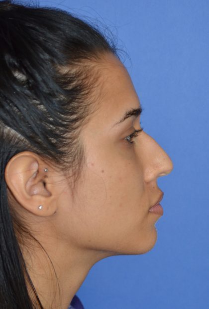 Rhinoplasty Before & After Patient #9995