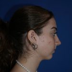 Rhinoplasty Before & After Patient #9996