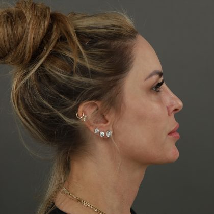 Rhinoplasty Before & After Patient #9997