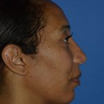 Regenelift™ Facelift Before & After Patient #9998