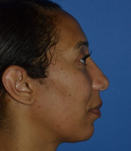 Regenelift™ Facelift Before & After Patient #9998