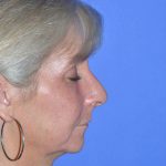 Regenelift™ Facelift Before & After Patient #9786