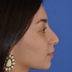 Rhinoplasty Before & After Patient #9999