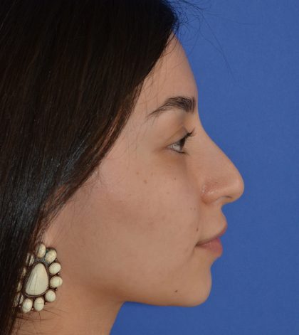 Rhinoplasty Before & After Patient #9999