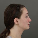 Rhinoplasty Before & After Patient #10000